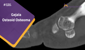 Read more about the article Gejala Osteoid Osteoma