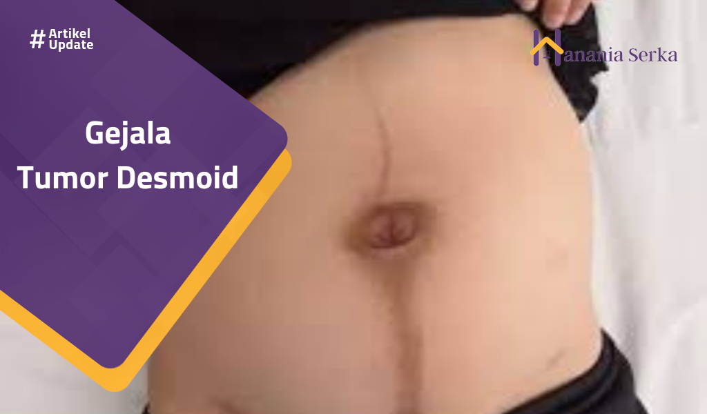 You are currently viewing Gejala Tumor Desmoid