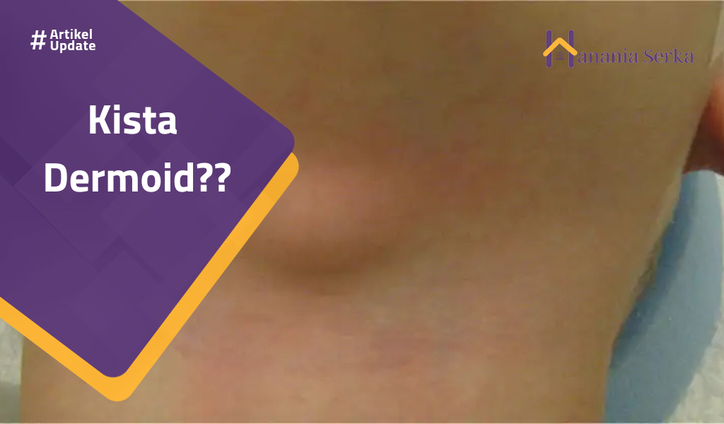 You are currently viewing Kista Dermoid??