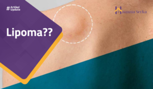 Read more about the article Lipoma??