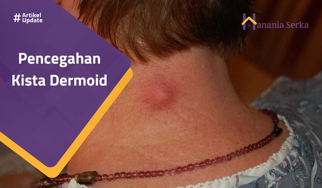 You are currently viewing Pencegahan Kista Dermoid