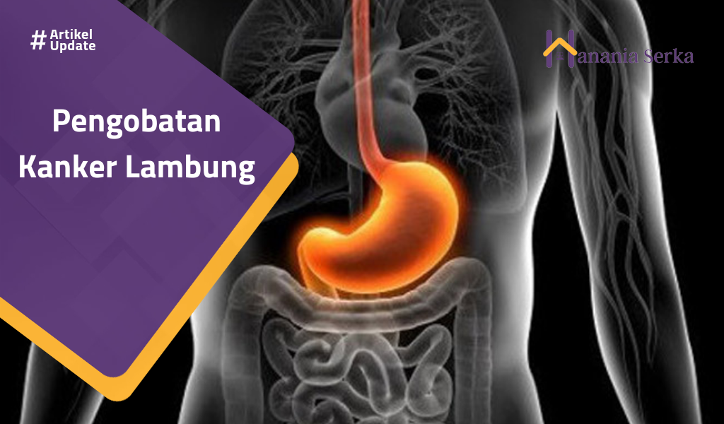 Read more about the article Pengobatan Kanker Lambung
