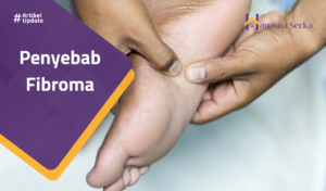 Read more about the article Penyebab Fibroma