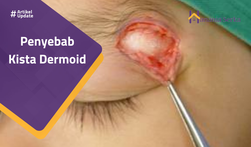 You are currently viewing Penyebab Kista Dermoid