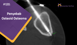 Read more about the article Penyebab Osteoid Osteoma