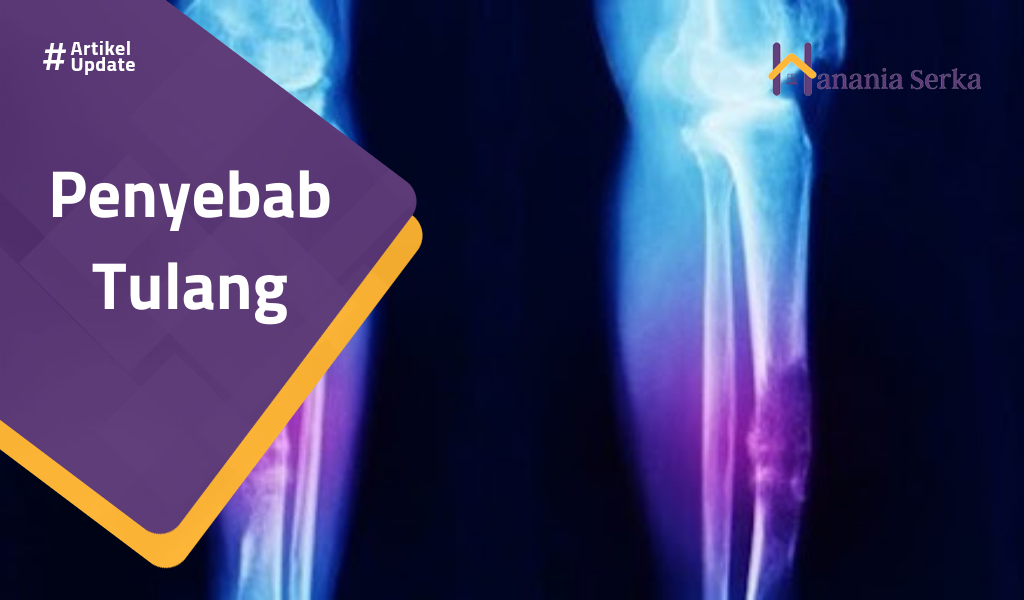 You are currently viewing Penyebab Kanker Tulang