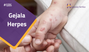 Read more about the article Gejala Herpes