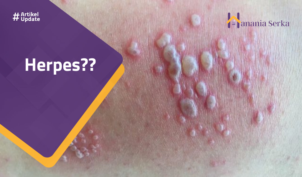 You are currently viewing Herpes??