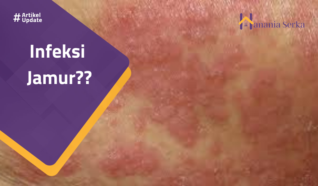 Read more about the article Infeksi Jamur??