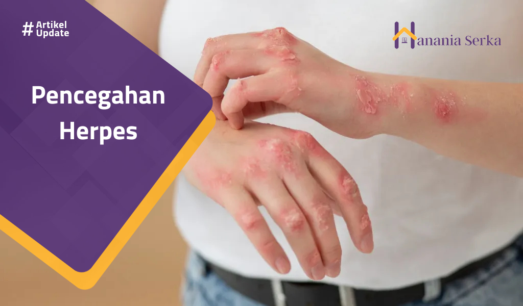 You are currently viewing Pencegahan Herpes