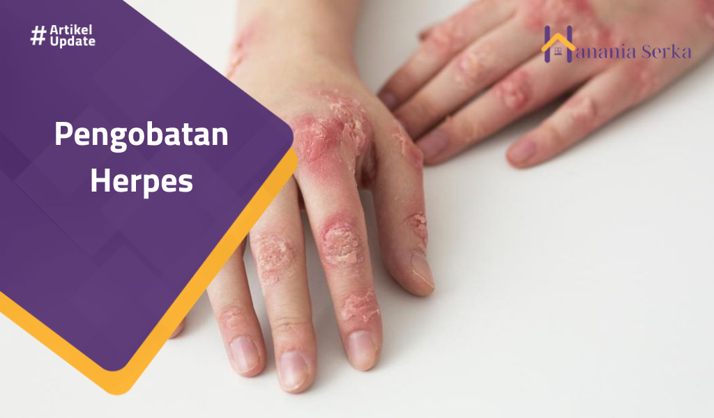 Read more about the article Pengobatan Herpes