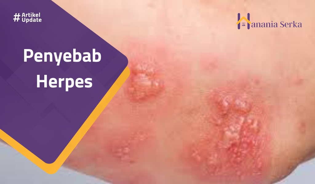 You are currently viewing Penyebab Herpes