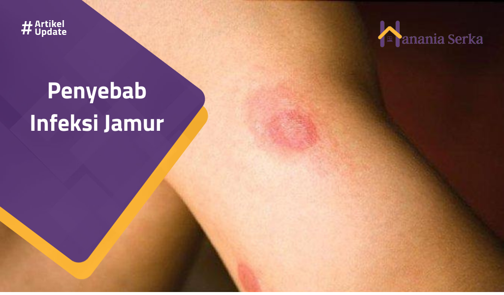 You are currently viewing Penyebab Infeksi Jamur