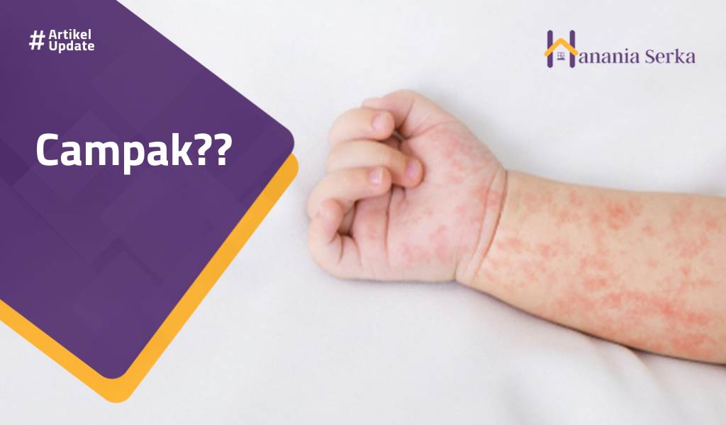 You are currently viewing Campak??