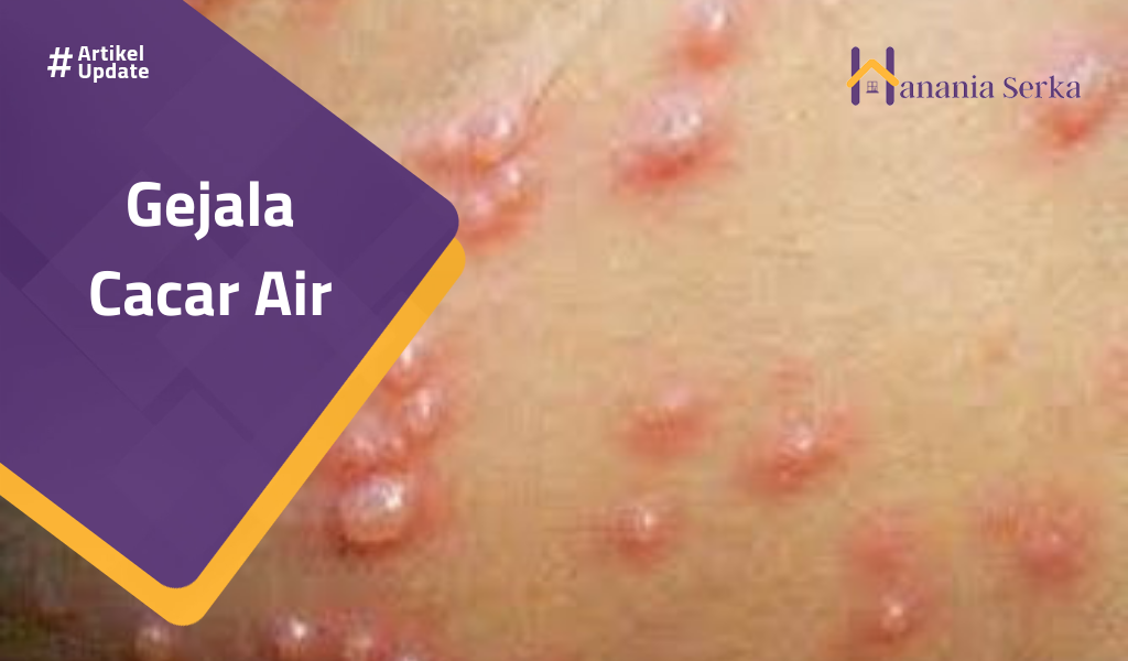 You are currently viewing Gejala Cacar Air