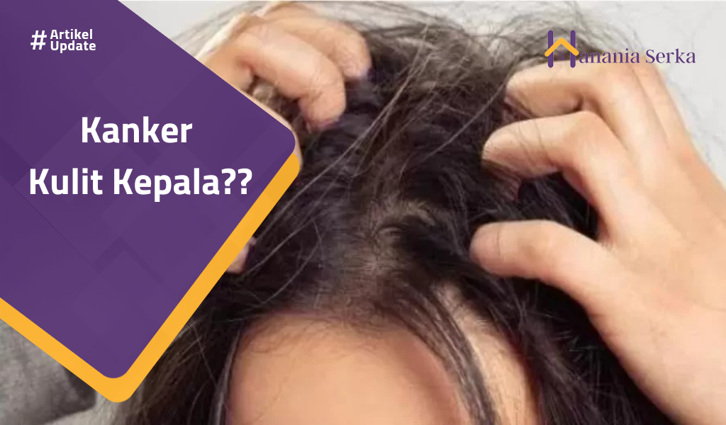 Read more about the article Kanker Kulit Kepala??