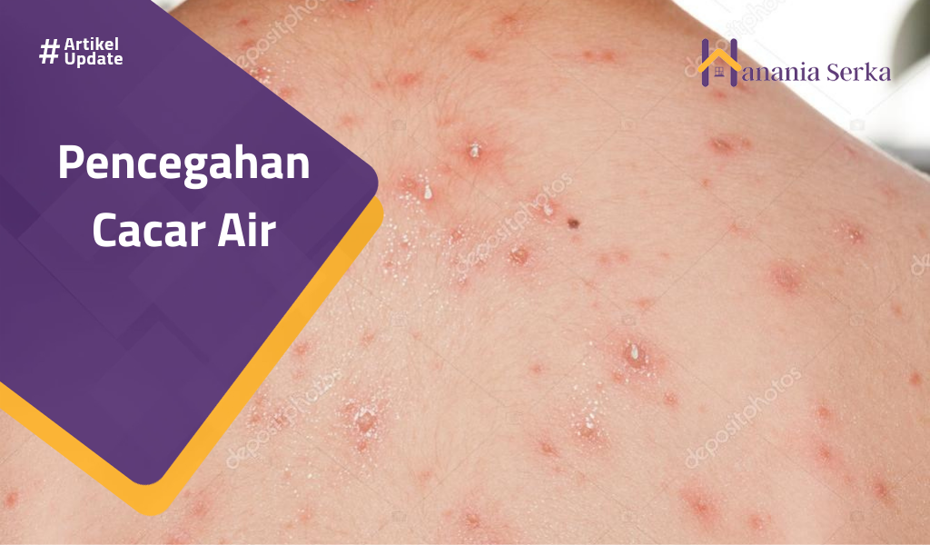 You are currently viewing Pencegahan Cacar Air