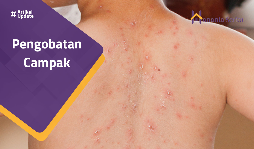 You are currently viewing Pengobatan Campak