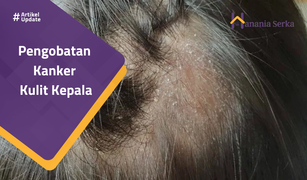You are currently viewing Pengobatan Kanker Kulit Kepala