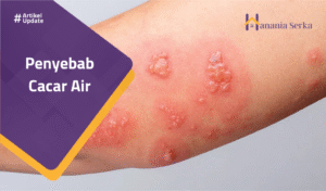 Read more about the article Penyebab Cacar Air