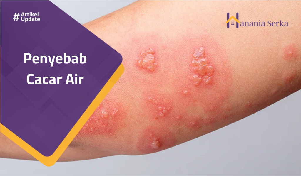 Read more about the article Penyebab Cacar Air