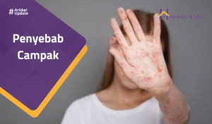 Read more about the article Penyebab Campak