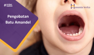Read more about the article Pengobatan Batu Amandel