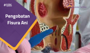 Read more about the article Pengobatan Fisura Ani