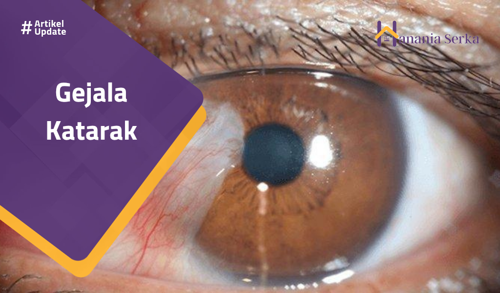 You are currently viewing Gejala Katarak