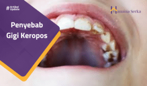 Read more about the article Penyebab Gigi Keropos