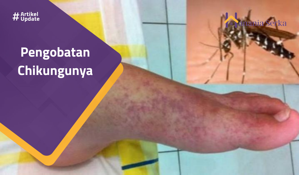 Read more about the article Pengobatan Chikungunya