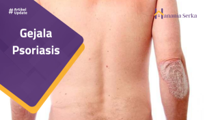 Read more about the article Gejala Psoriasis