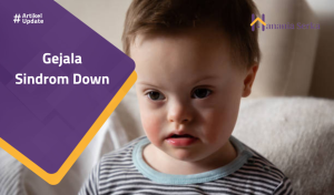 Read more about the article Gejala Sindrom Down