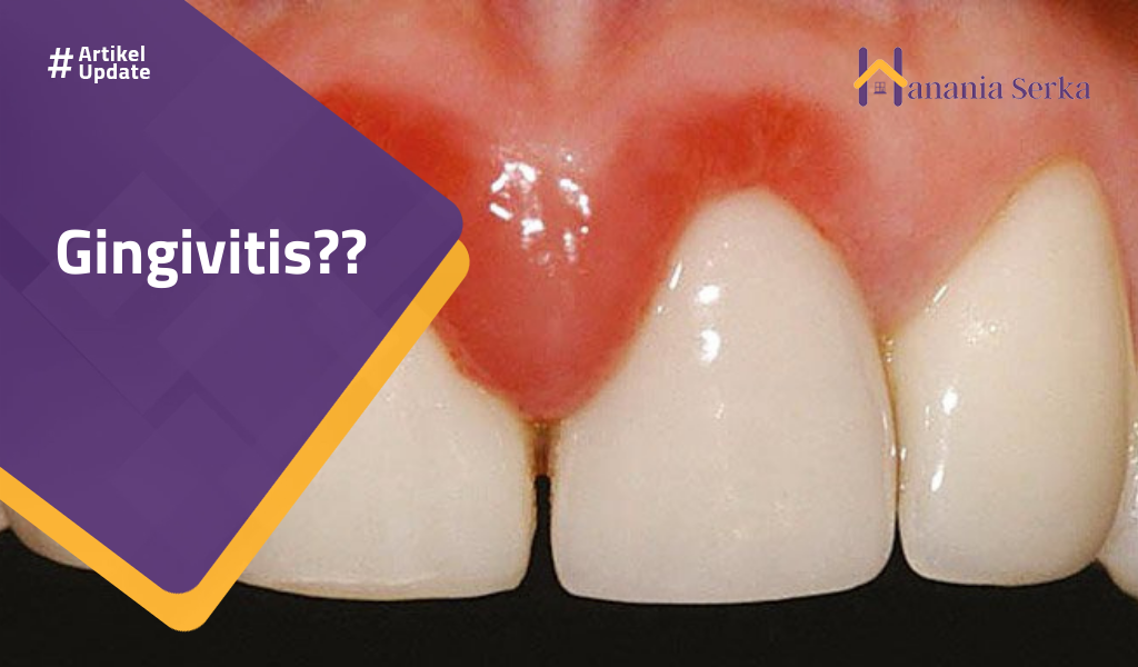 You are currently viewing Gingivitis??