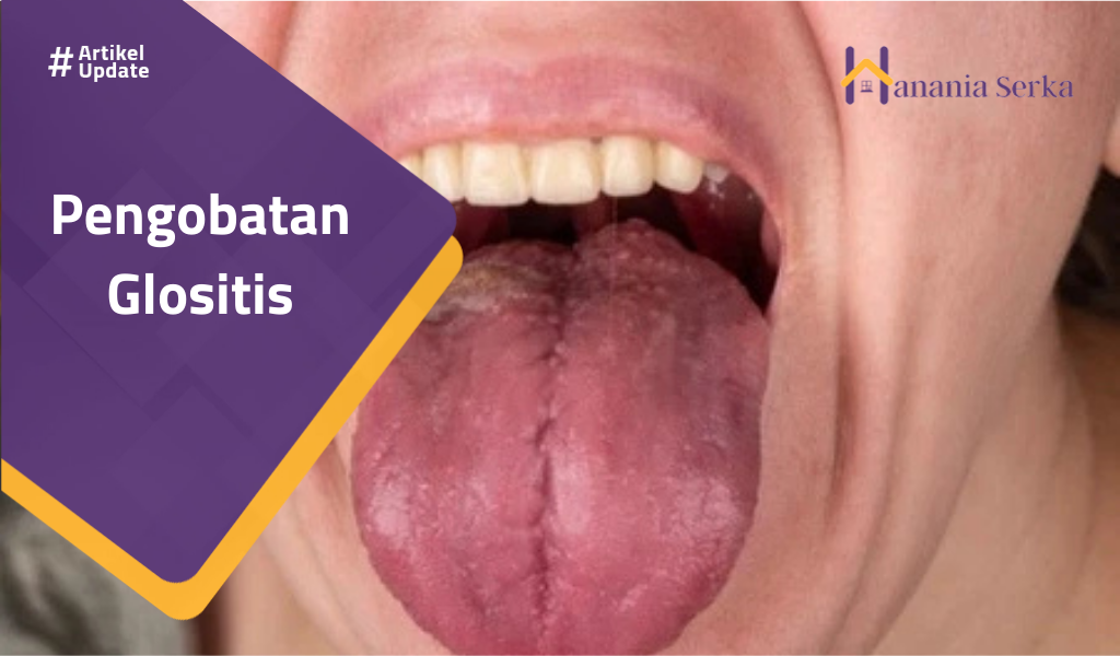 Read more about the article Pengobatan Glositis