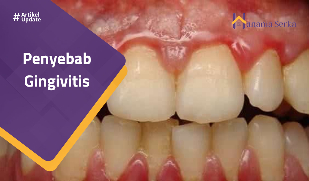 You are currently viewing Penyebab Gingivitis