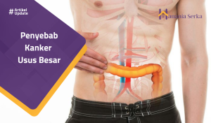 Read more about the article Penyebab Kanker Usus Besar