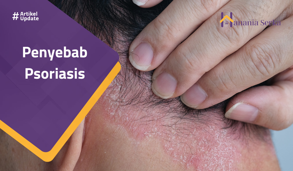 You are currently viewing Penyebab Psoriasis