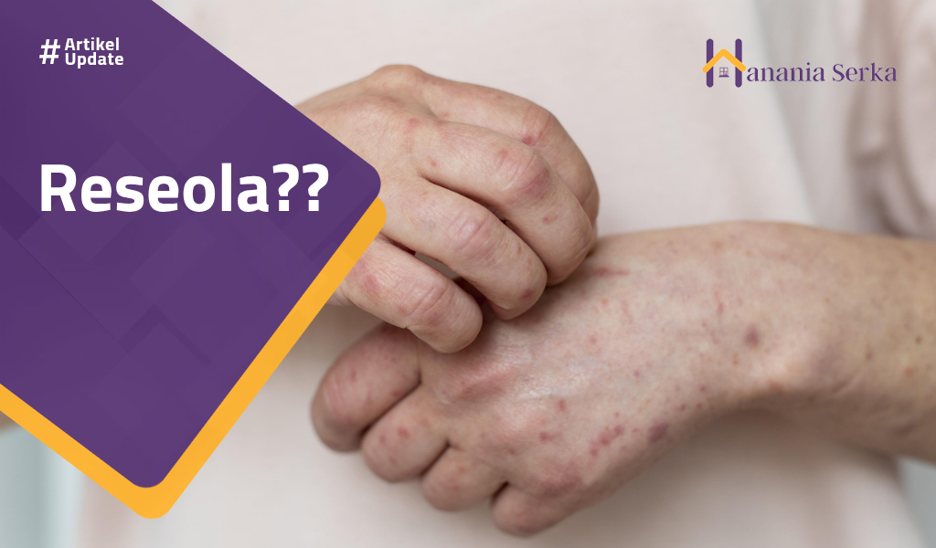 You are currently viewing Roseola??