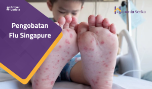 Read more about the article Pengobatan Flu Singapure