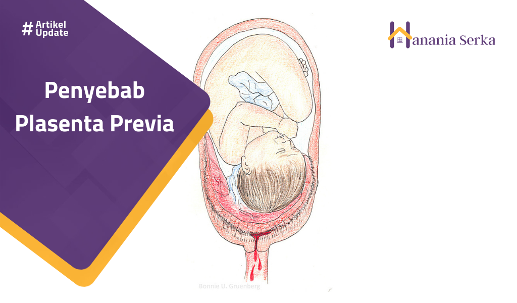 Read more about the article Penyebab Plasenta Previa