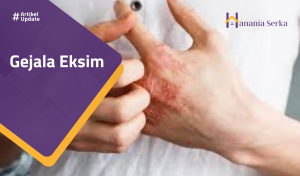Read more about the article Gejala Eksim