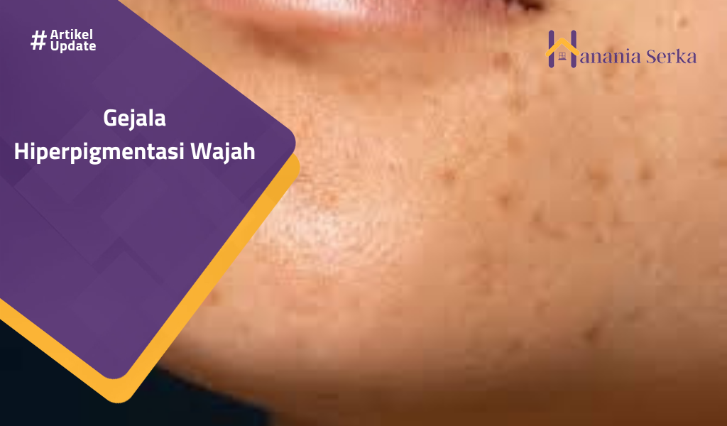 You are currently viewing Gejala Hiperpigmentasi Wajah