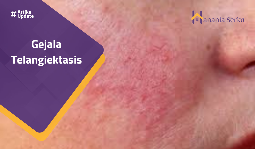 You are currently viewing Gejala Telangiektasis