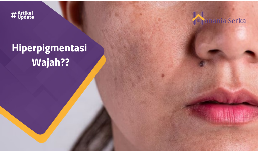Read more about the article Hiperpigmentasi Wajah??