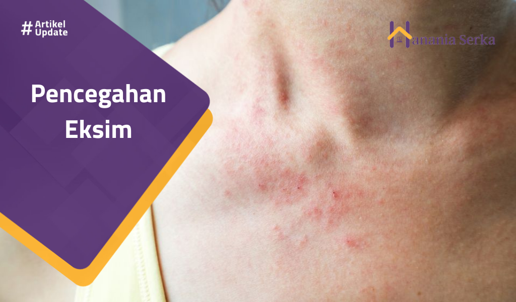 Read more about the article Pencegahan Eksim
