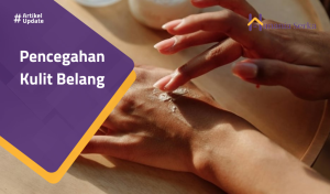 Read more about the article Pencegahan Kulit Belang