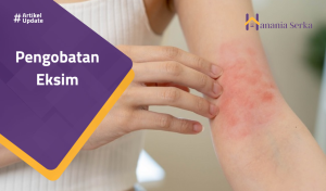 Read more about the article Pengobatan Eksim