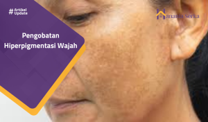 Read more about the article Pengobatan Hiperpigmentasi Wajah