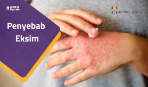 Read more about the article Penyebab Eksim